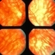 Birdshot Retinochoroidopathy